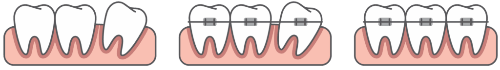 Braces teeth step illustration vector on blue background. Dental concept.