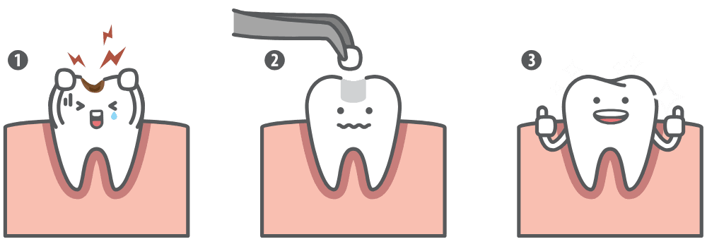 Dental cartoon Step of restoring cavity tooth by filling tooth illustration cartoon character vector design on blue background. Dental care concept.
