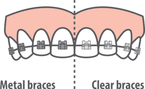 Illustration showing a side-by-side comparison of traditional metal braces and clear braces on upper teeth – Braces.
