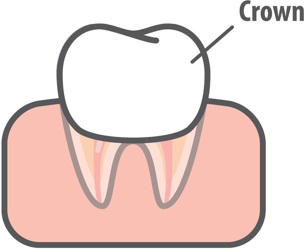 Educational diagram showing a tooth fitted with a crown for protection and restoration – Tooth-Colored Baby Crowns.