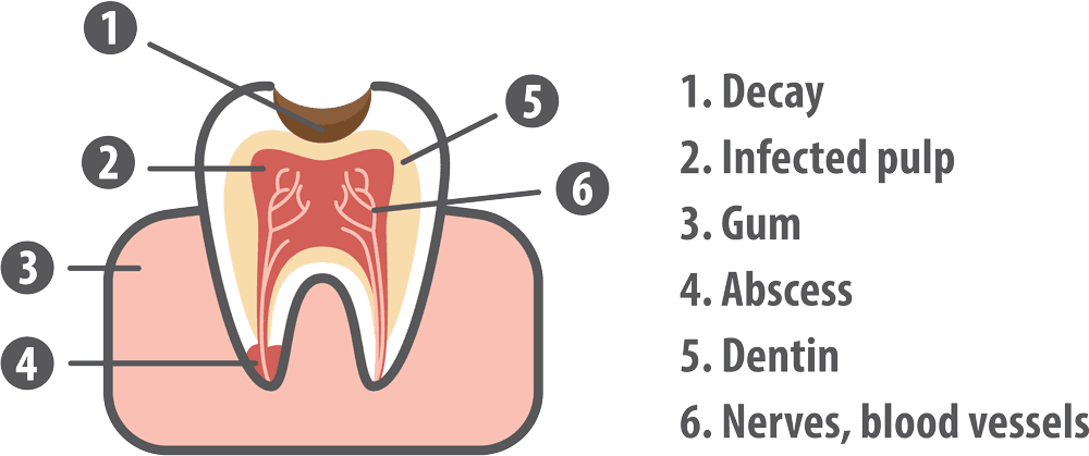 Tooth Anatomy Diagram with Decay – Pediatric Root Canals Detailed diagram of a tooth showing decay, infected pulp, dentin, abscess, and nerves for dental education – Pediatric Root Canals.