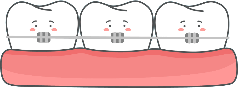 Cute cartoon illustration of three teeth with braces, aligned in pink gums and smiling shyly – Braces.